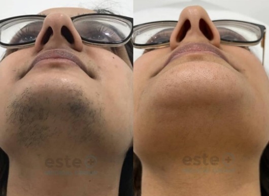 negative effects from laser hair removal